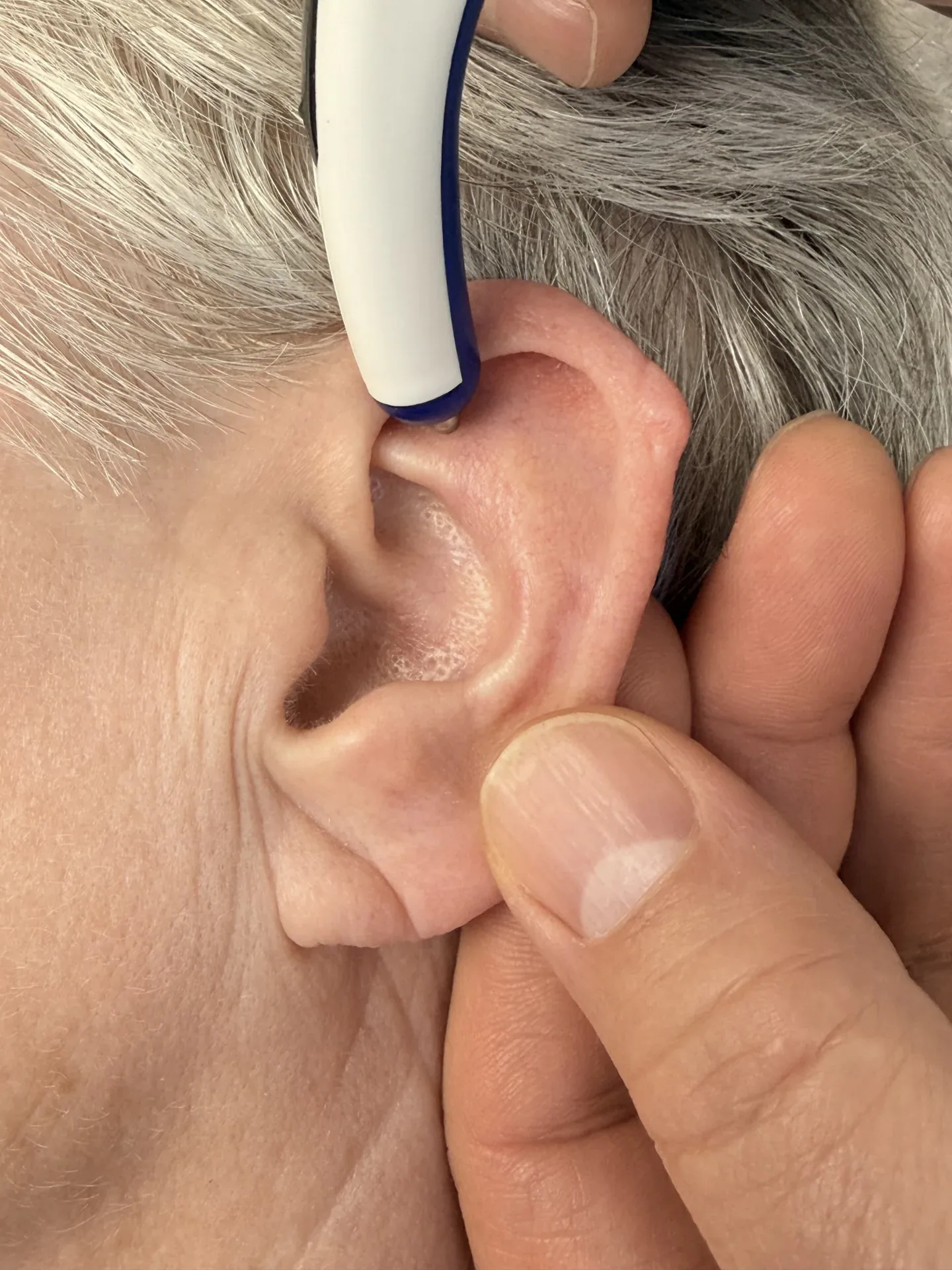 Practitioner stimulating auriculotherapy point on a patient's ear