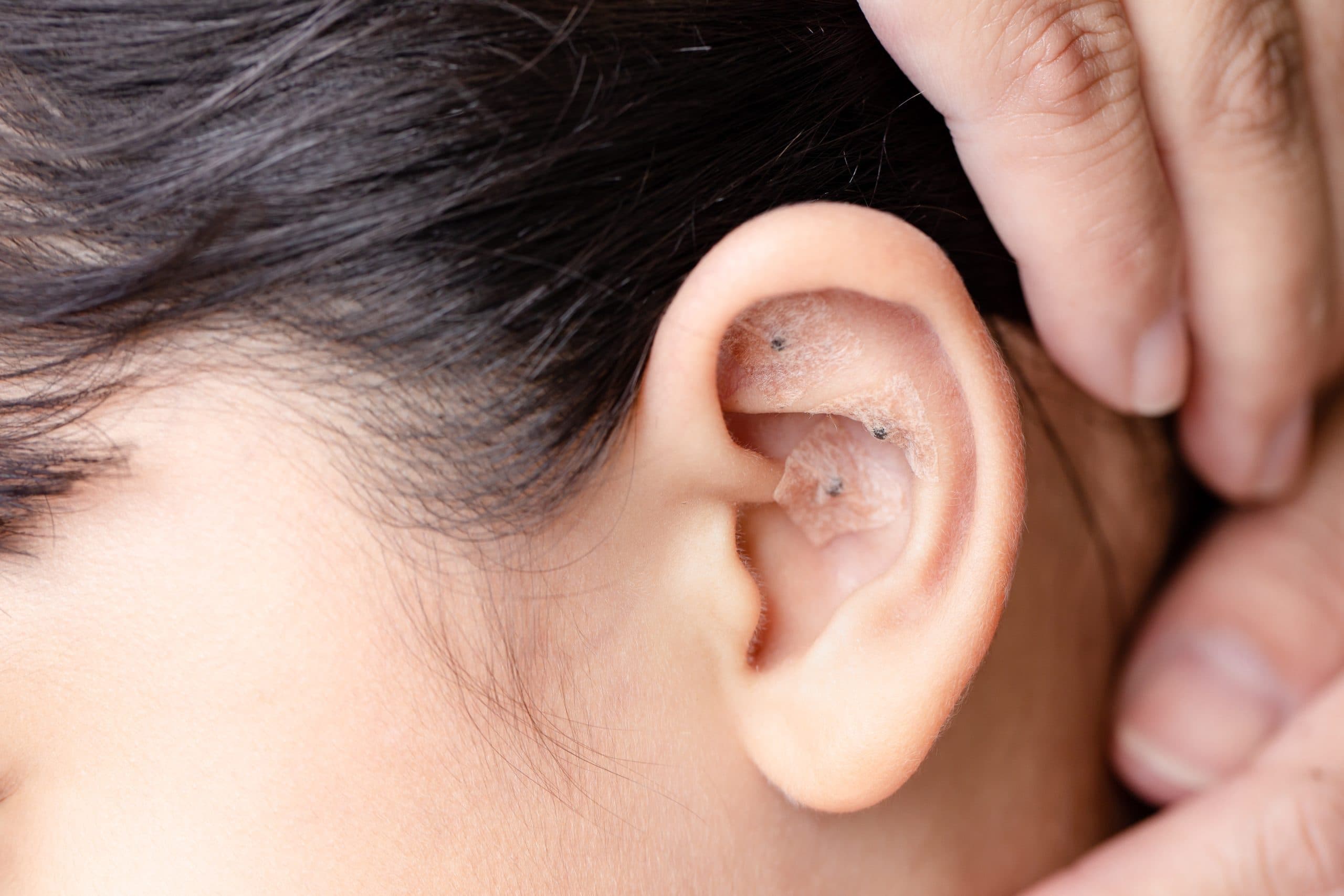 Practitioner stimulating auriculotherapy point on a patient's ear